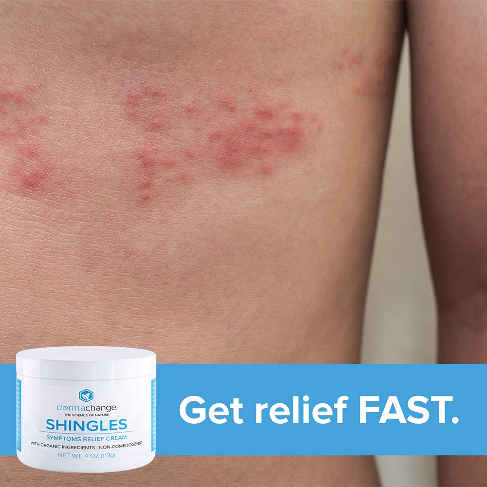 How To Stop Itching And Burning From Shingles