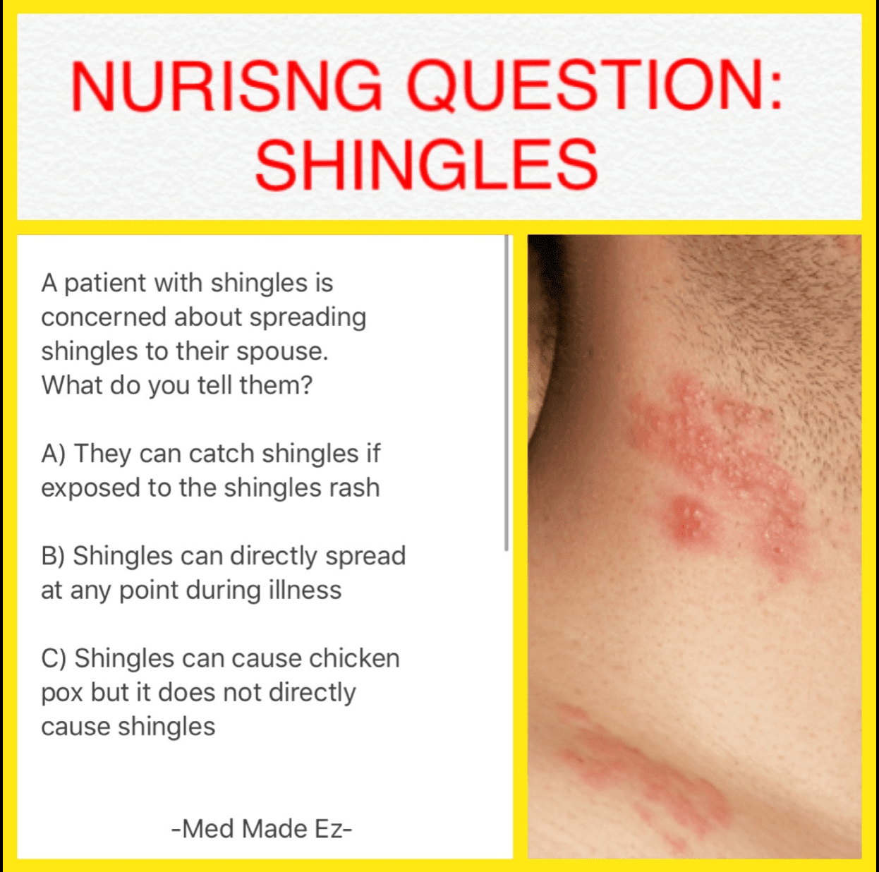 How To Test For Shingles Without Rash