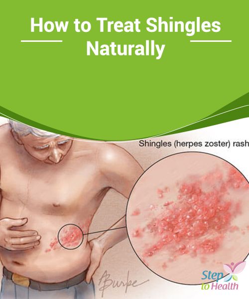 How to #Treat Shingles Naturally Learn a little more about this # ...