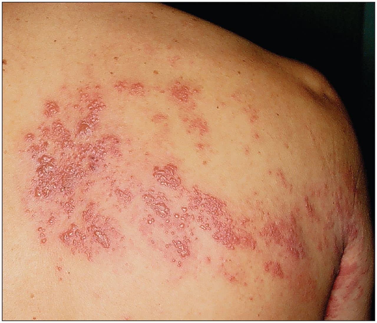 How Would I Know If I Have Shingles