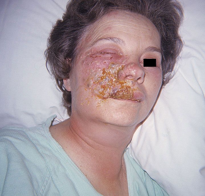 Hsv Rash Face : Herpes zoster blisters on woman