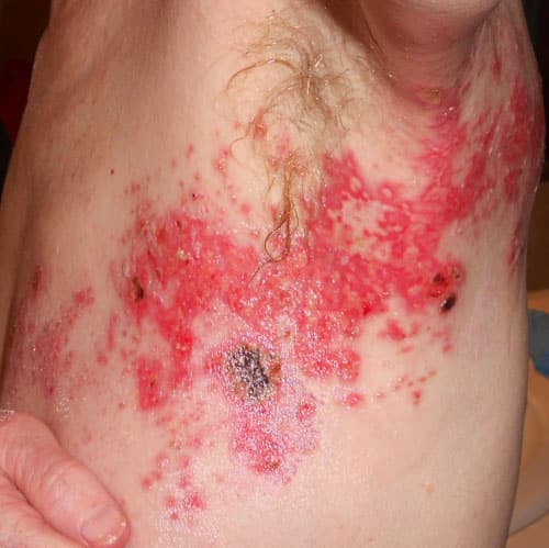 I got SHINGLES for Summer! **Warning! Ugly pictures that might turn ...