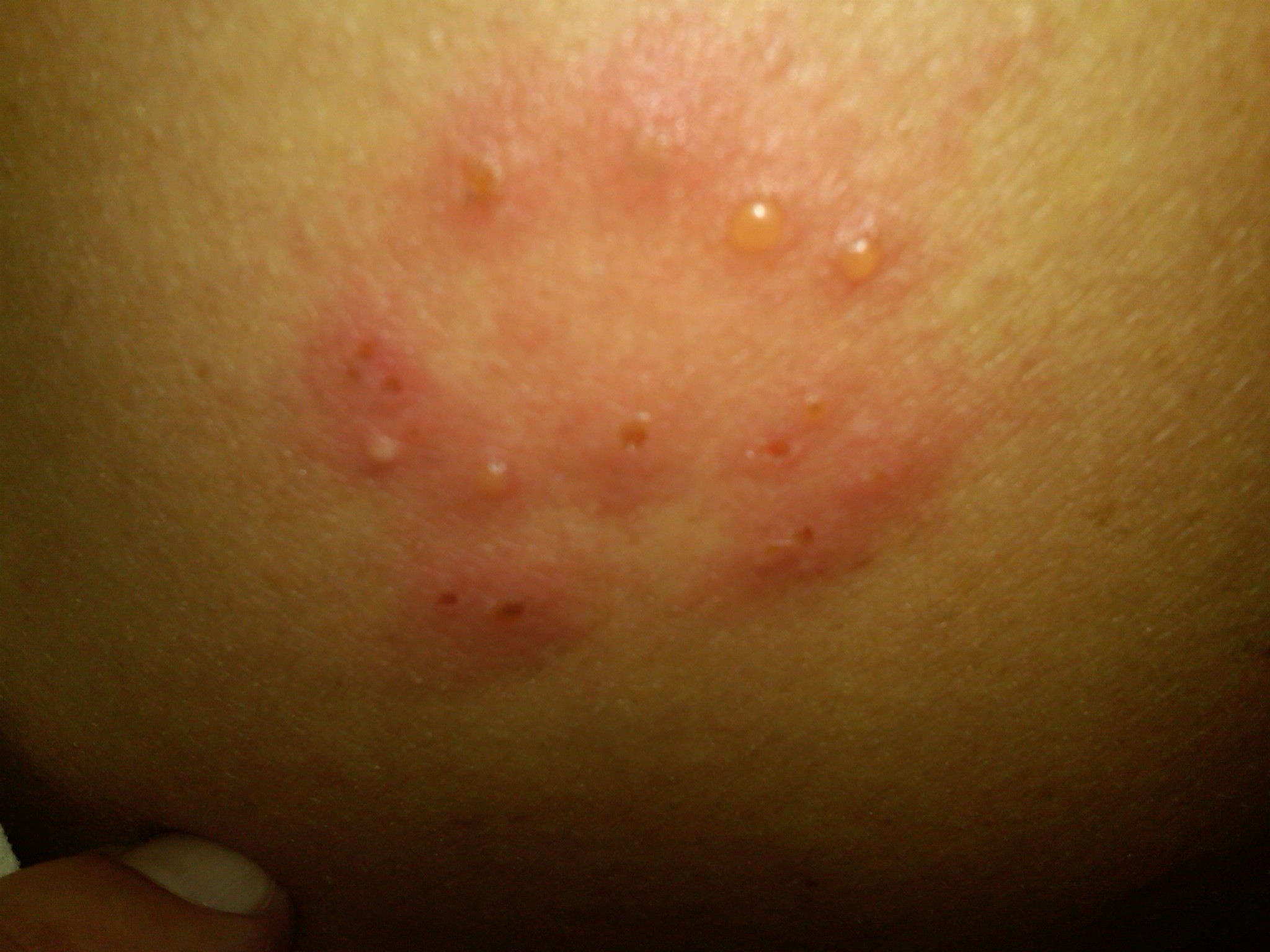 i think i have shingles. i took a phot, can i email it to