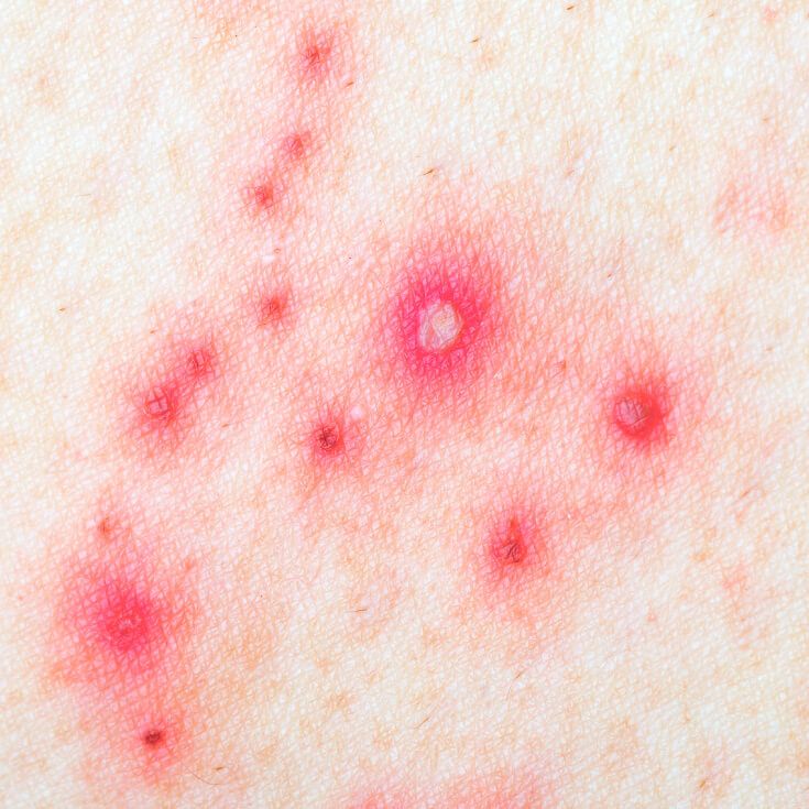 If You Have These Symptoms, You May Have Shingles