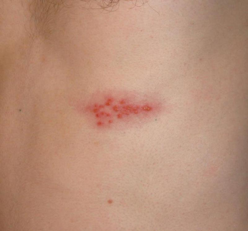 Images Of People With Shingles