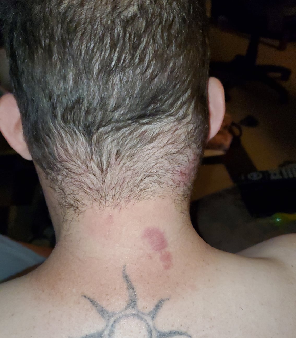 Images Of Shingles On Neck / Adolescent female presents with painful ...