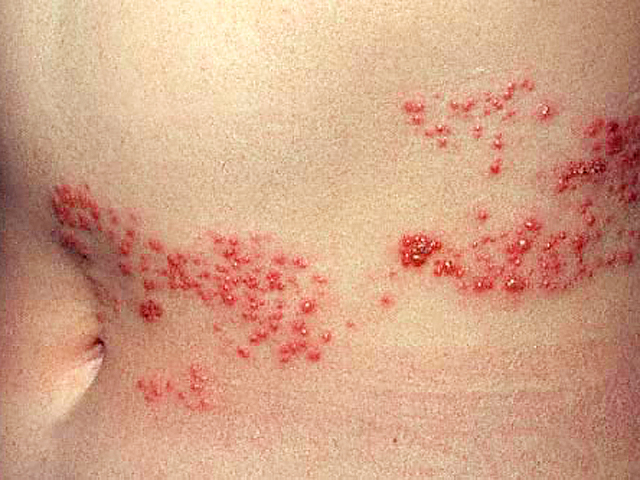 Is it shingles? 7 myths about painful illness (graphic images)