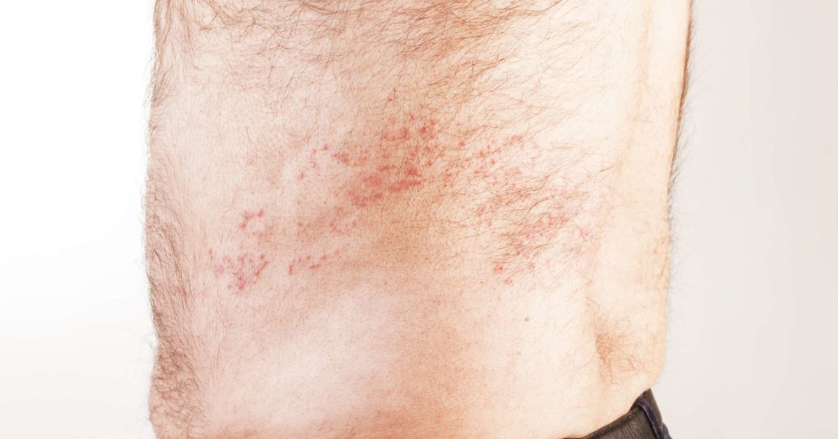 Is it shingles? Symptoms, vs. other conditions, and causes