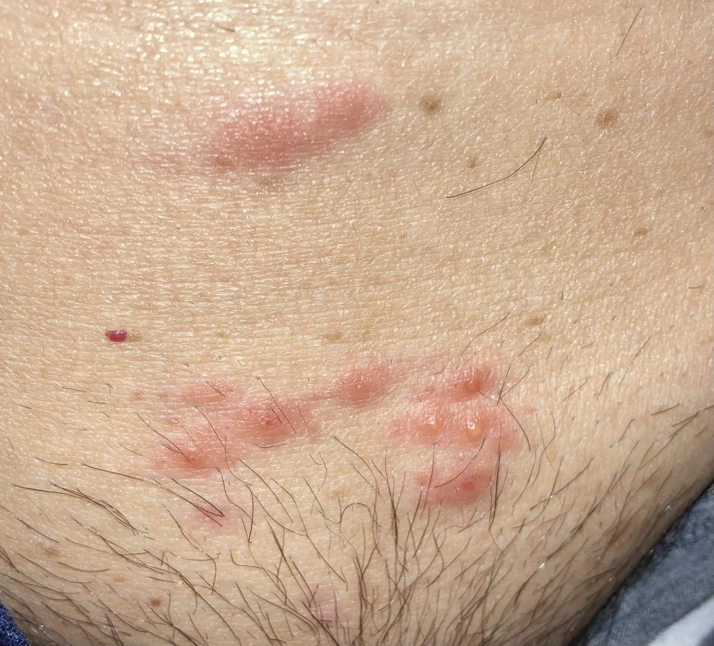 Is this shingles? A little itchy/sore. No other symptoms. : medical_advice
