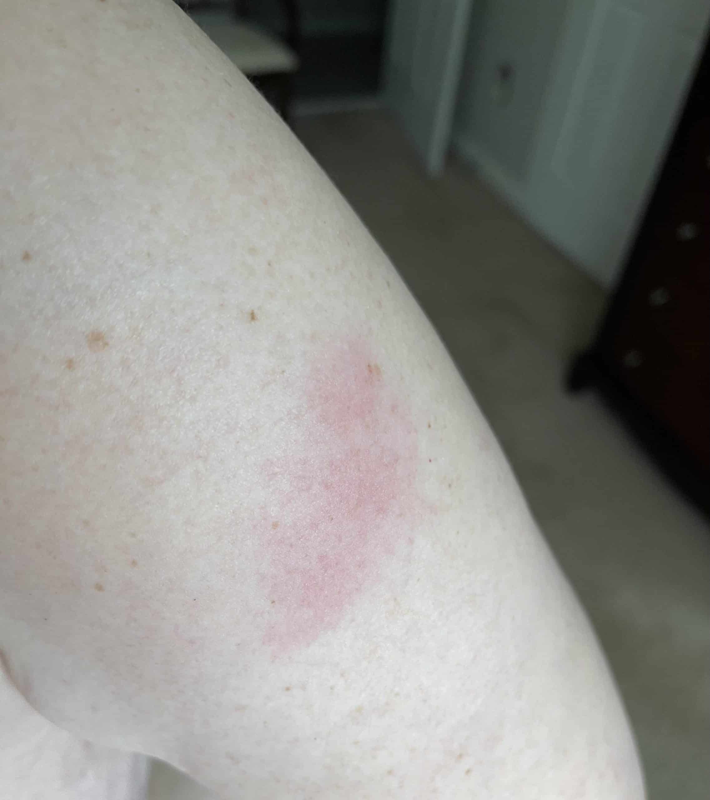 Is this shingles? Just got to Cancun. At the hospital doctor. He thinks ...