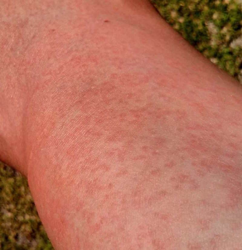 Maculopapular rash: Causes, treatment, and pictures