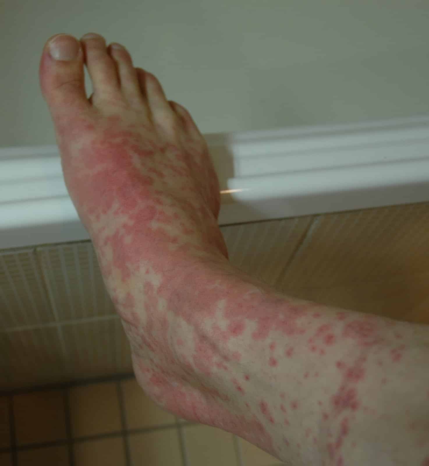 my atripla rash experience: day 11