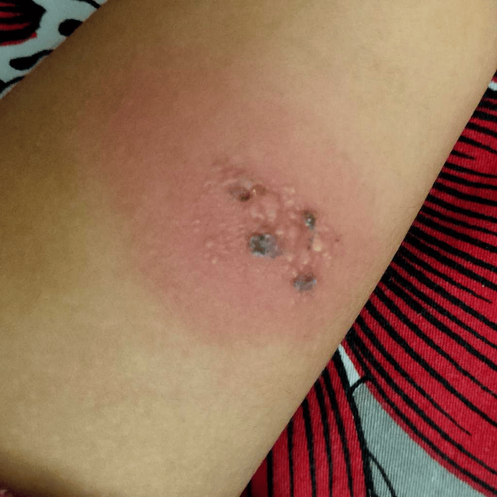 my daughter has one rash type thing on her leg which showed only this ...