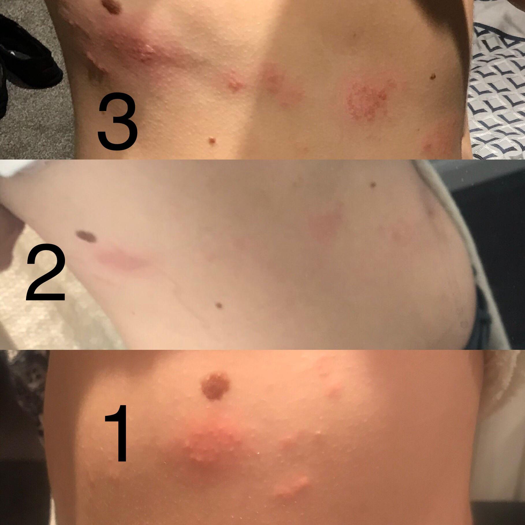 My shingles progression. Just in case it helps others to recognise it ...
