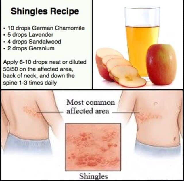 Natural shingles recipe because you never know!