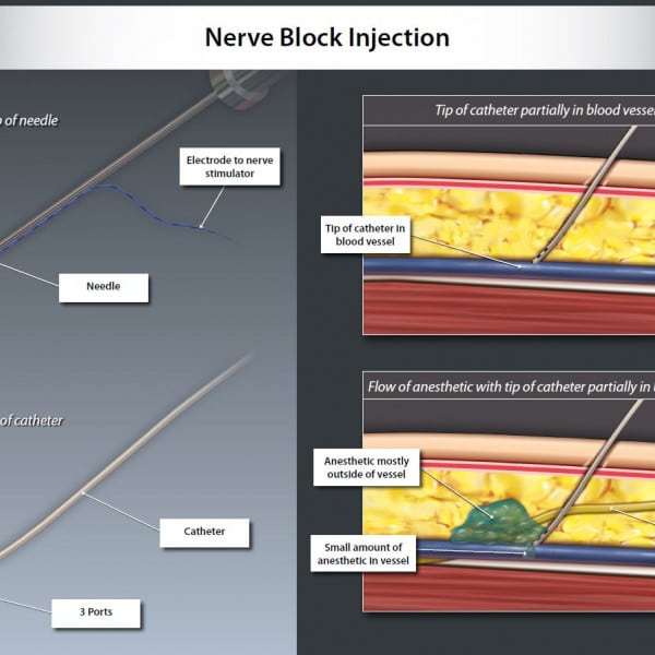 Nerve Block Injection