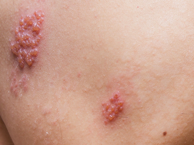 New Shingles Vaccine May Have Higher Efficacy in Older Adults