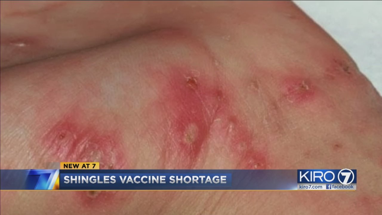 New shingles vaccine very effective, hard to find  KIRO 7 News Seattle
