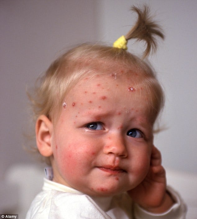 Now children could get a vaccine for chickenpox if trials prove ...