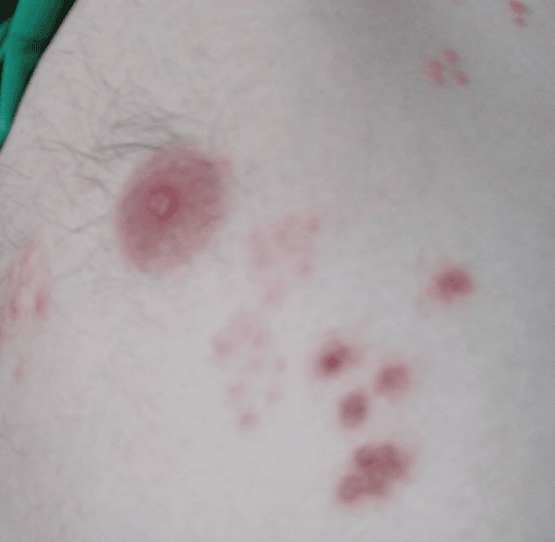 Outbreak Hsv 2 Pictures On Buttocks : Shingles