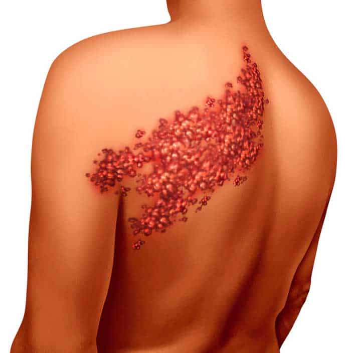 Painful Rash? It Could be Shingles
