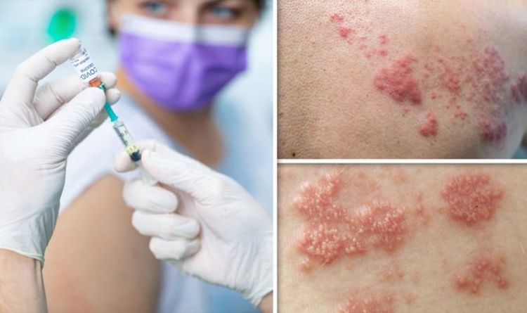 Pfizer vaccine side effects: Six cases of shingles identified in ...