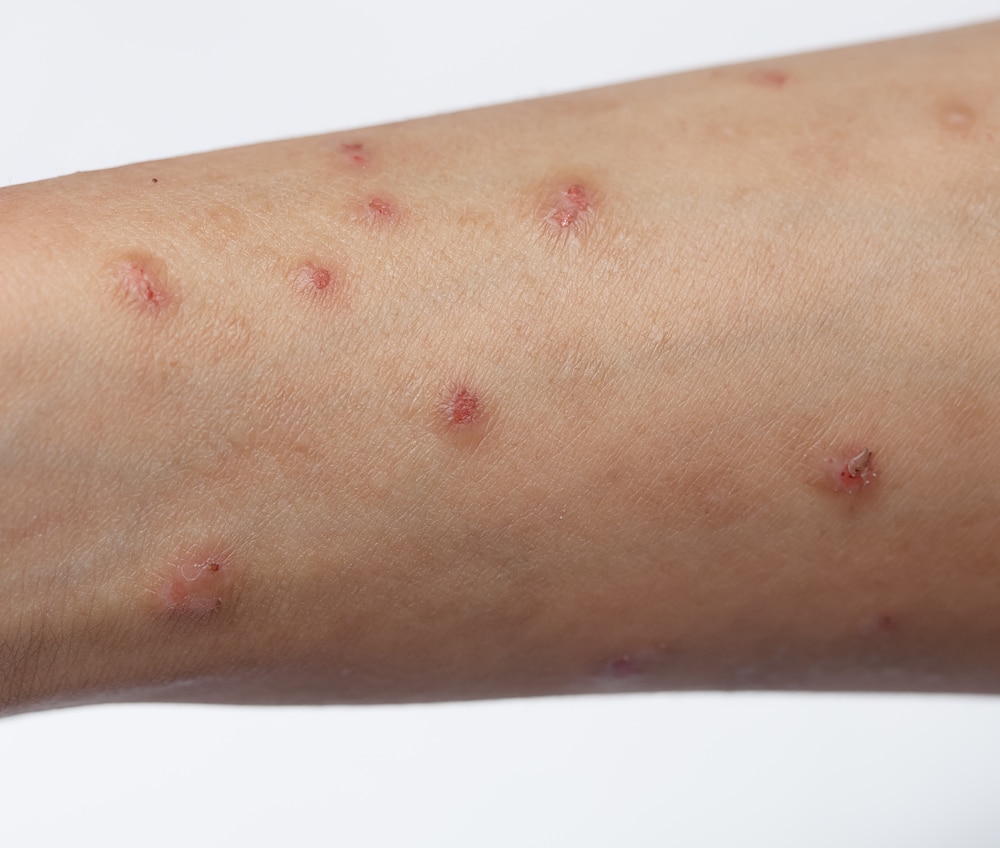 Picato Gel Side Effects Linked To Shingles, Severe Allergic Reactions ...