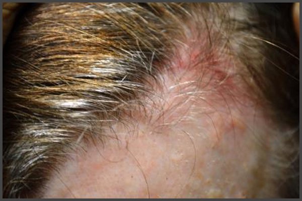 Pictures of shingles on the scalp