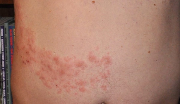Pictures of Shingles Rash (part 2)