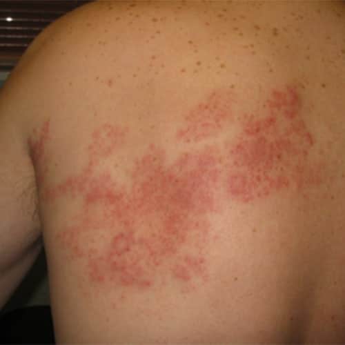 Post Herpes Zoster Pain Treatment in Delhi