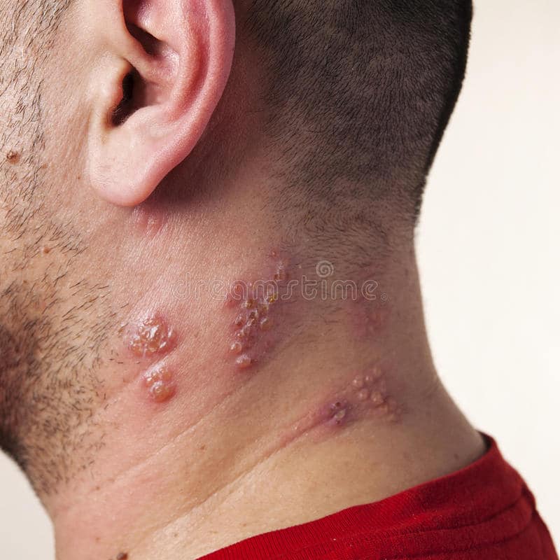 Raised Red Bumps And Blisters Caused By The Shingles Virus Stock Photo ...