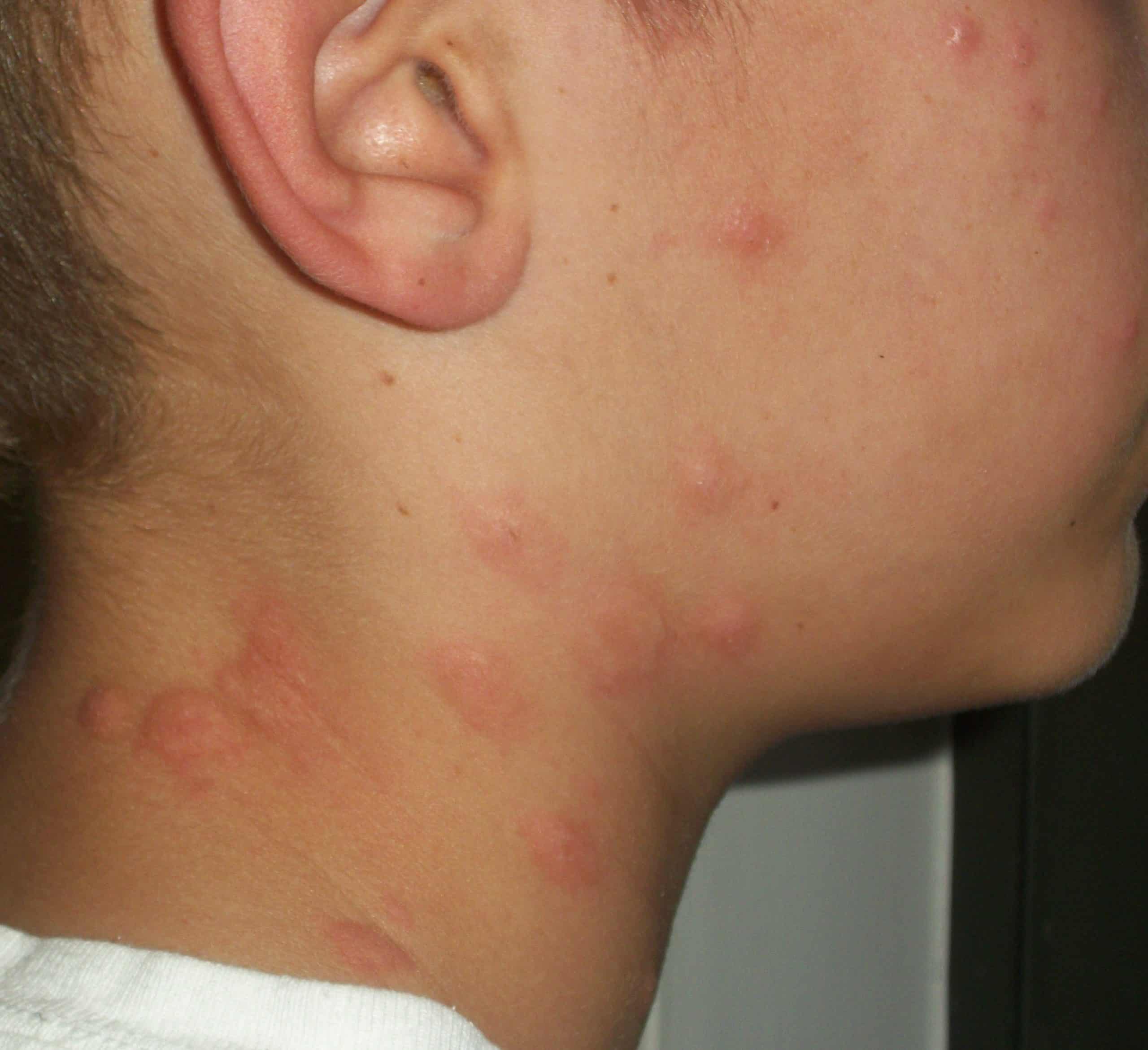 rash..which goes down around the back of his neck..size of a pin head