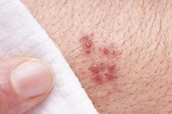 Reactions to the Shingles Vaccine