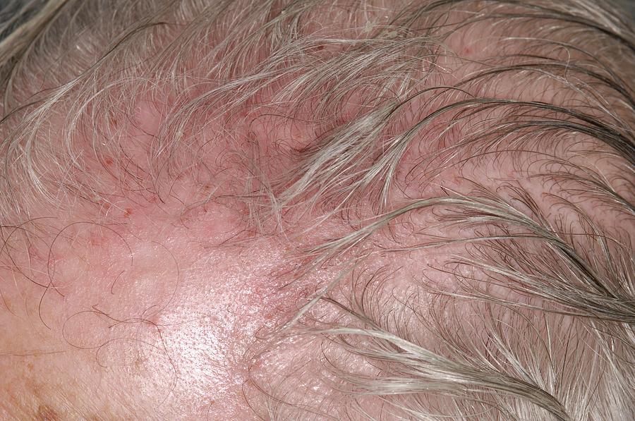 Scalp Irritation After Shingles Photograph by Dr P. Marazzi/science ...