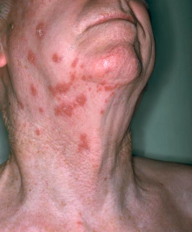 Shingles, a more painful version of chickenpox, vaccine recommended for ...