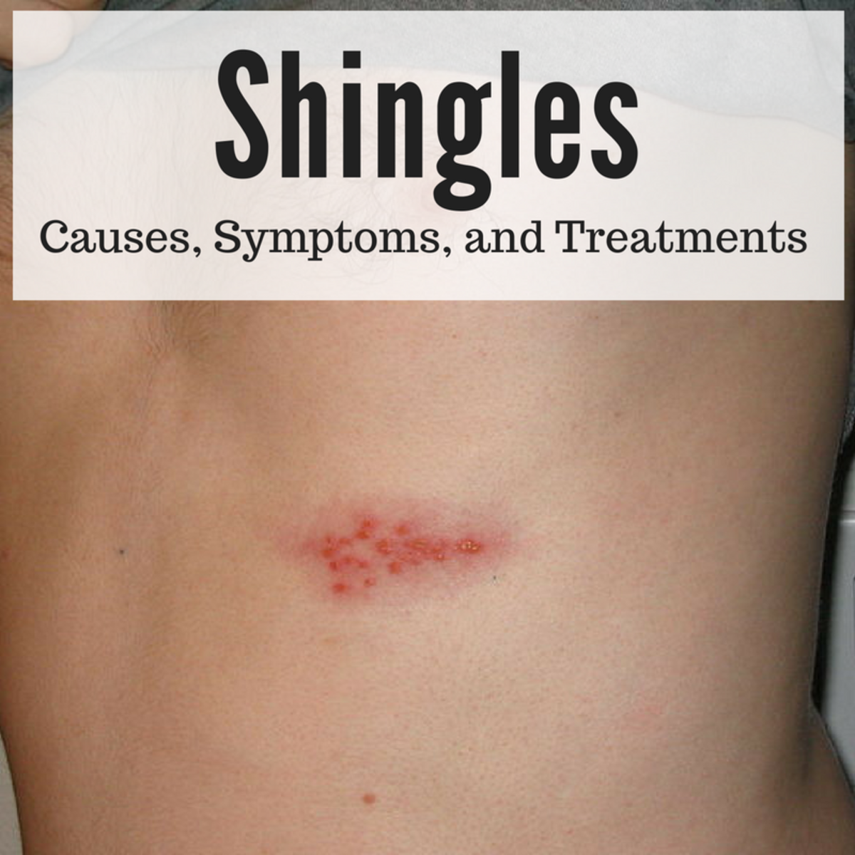 Shingles: A Serious and Painful Disease