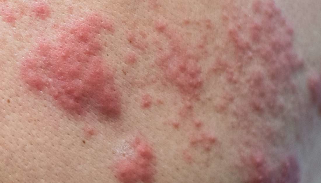 Shingles and HIV: What is the link?