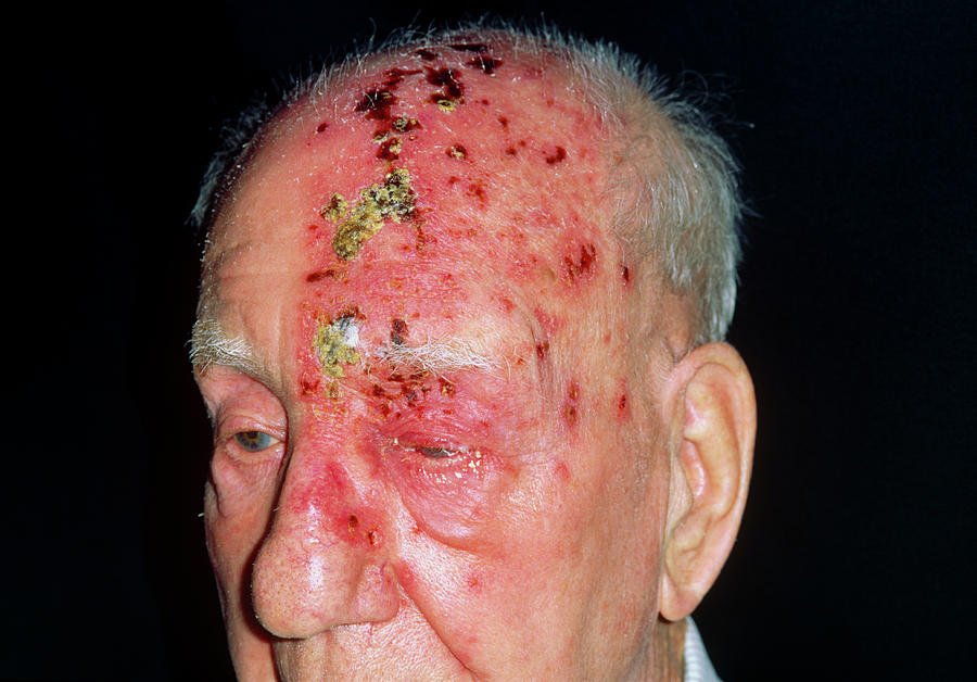 Shingles Attack On Head Of Elderly Male Photograph by Dr P. Marazzi ...