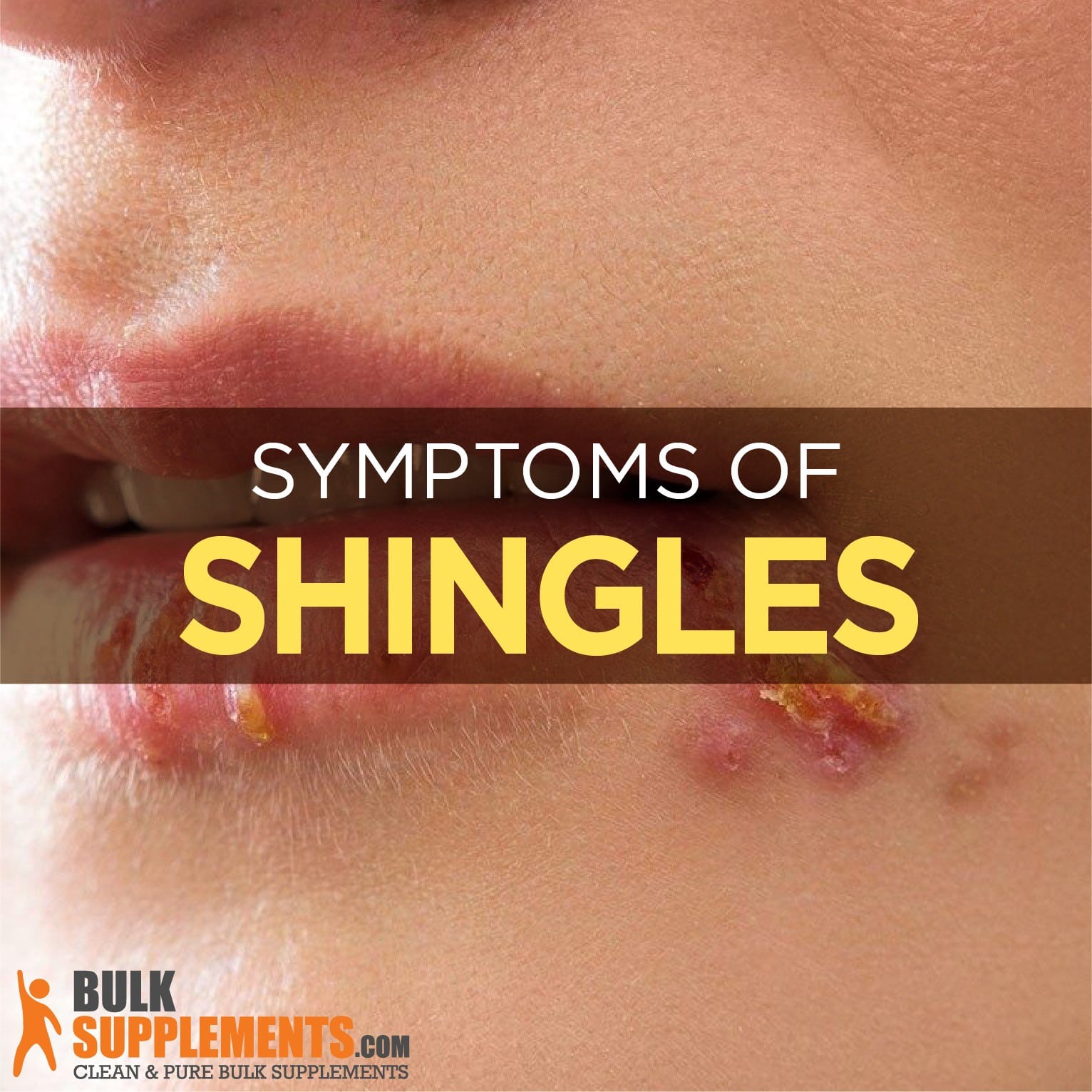 Shingles: Causes, Symptoms &  Treatment