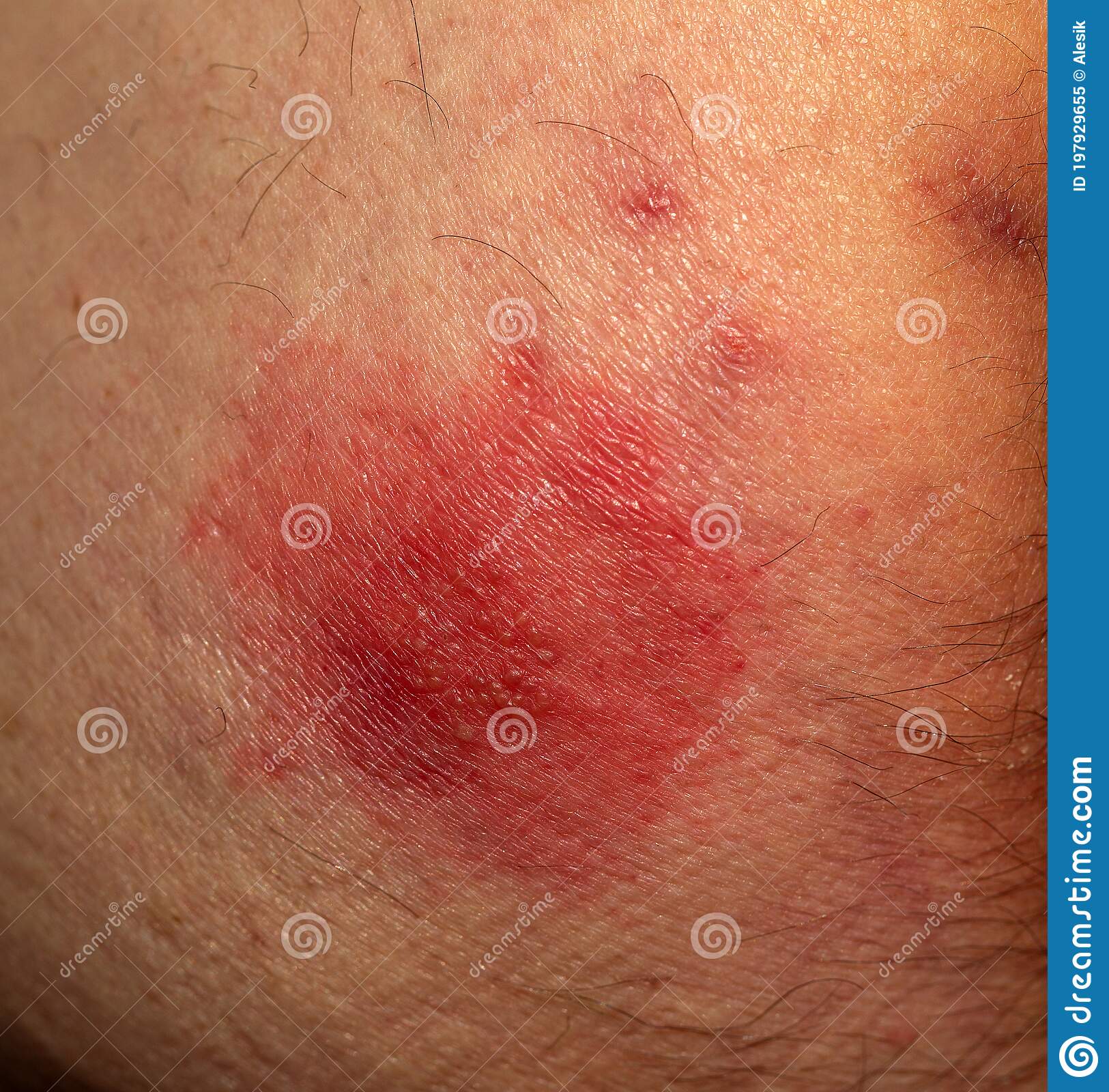 Shingles Disease. Sympton Of The Herpes Virus On The Human Body. Skin ...