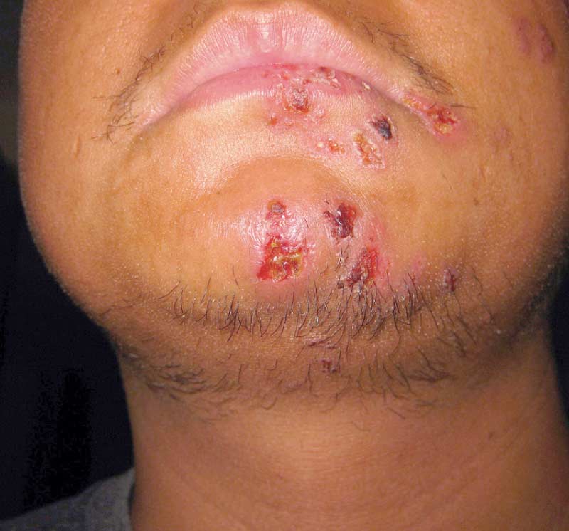 Shingles, Herpes Zoster