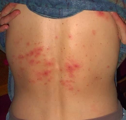 Shingles Herpes Zoster Treatment, Causes, Symptoms, Vaccine