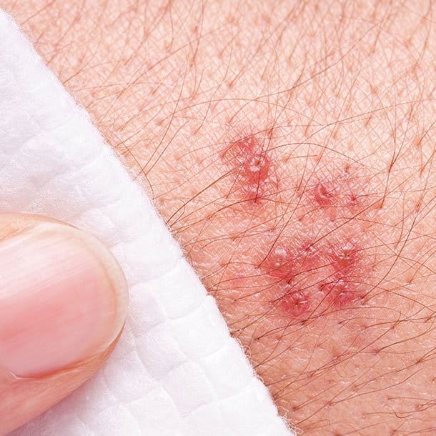 Shingles: Myths and Facts About the Shingles Virus
