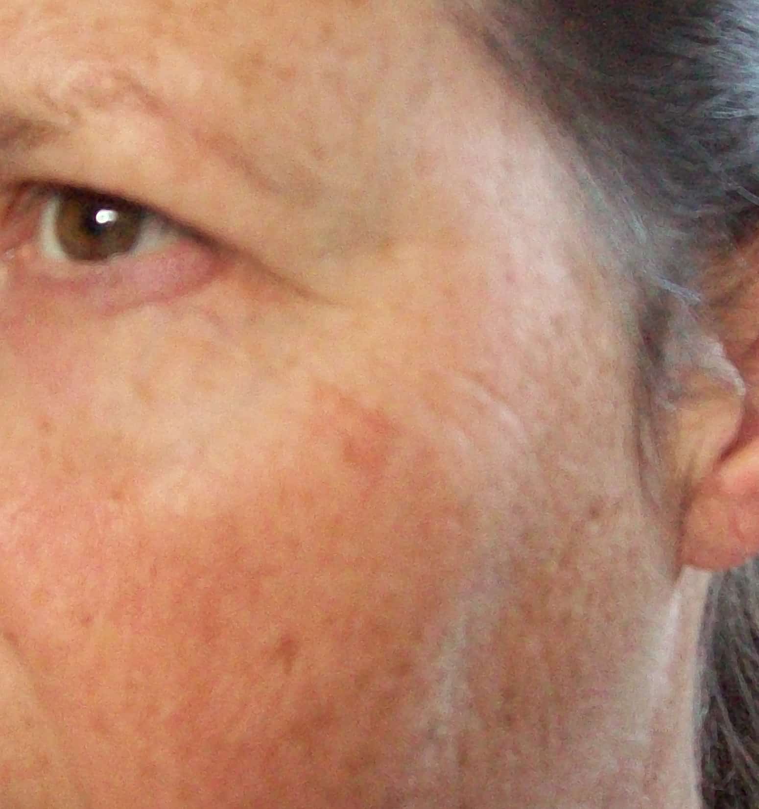 shingles on face images