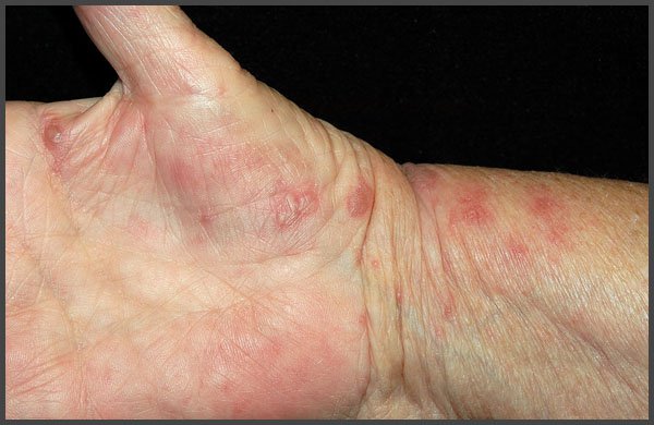 Shingles on hands pictures