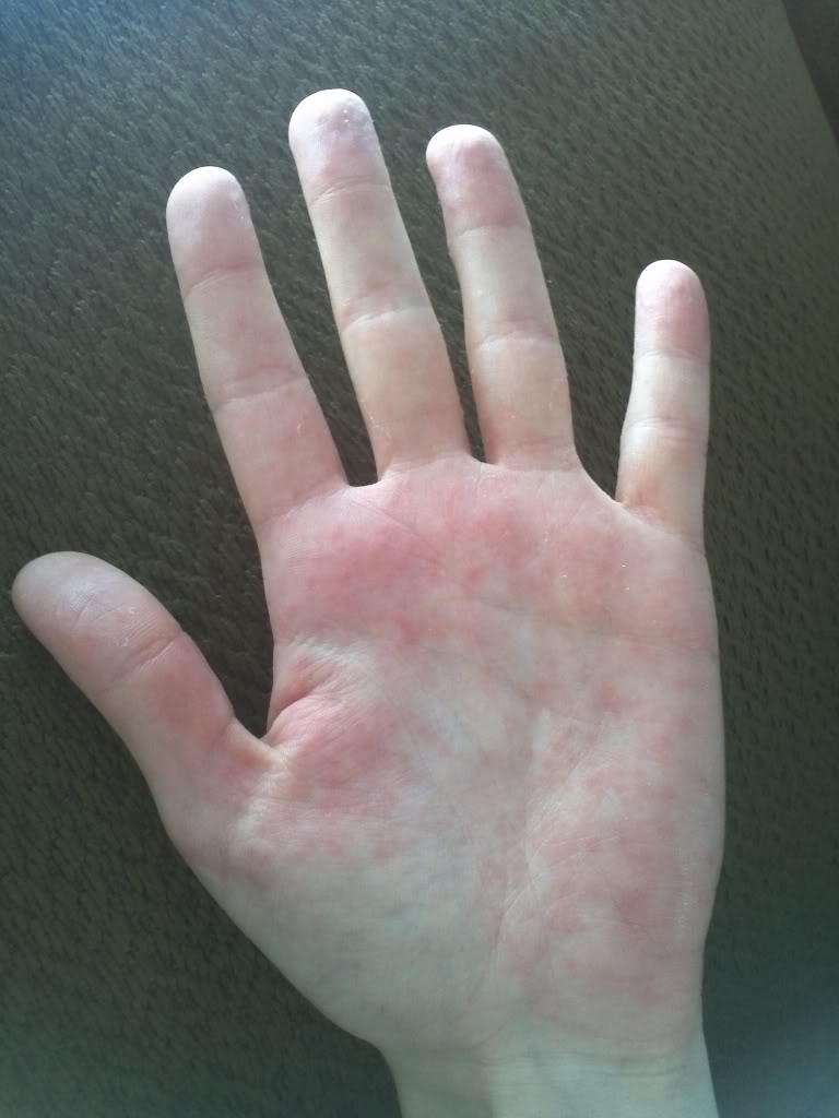 shingles on palms of hands