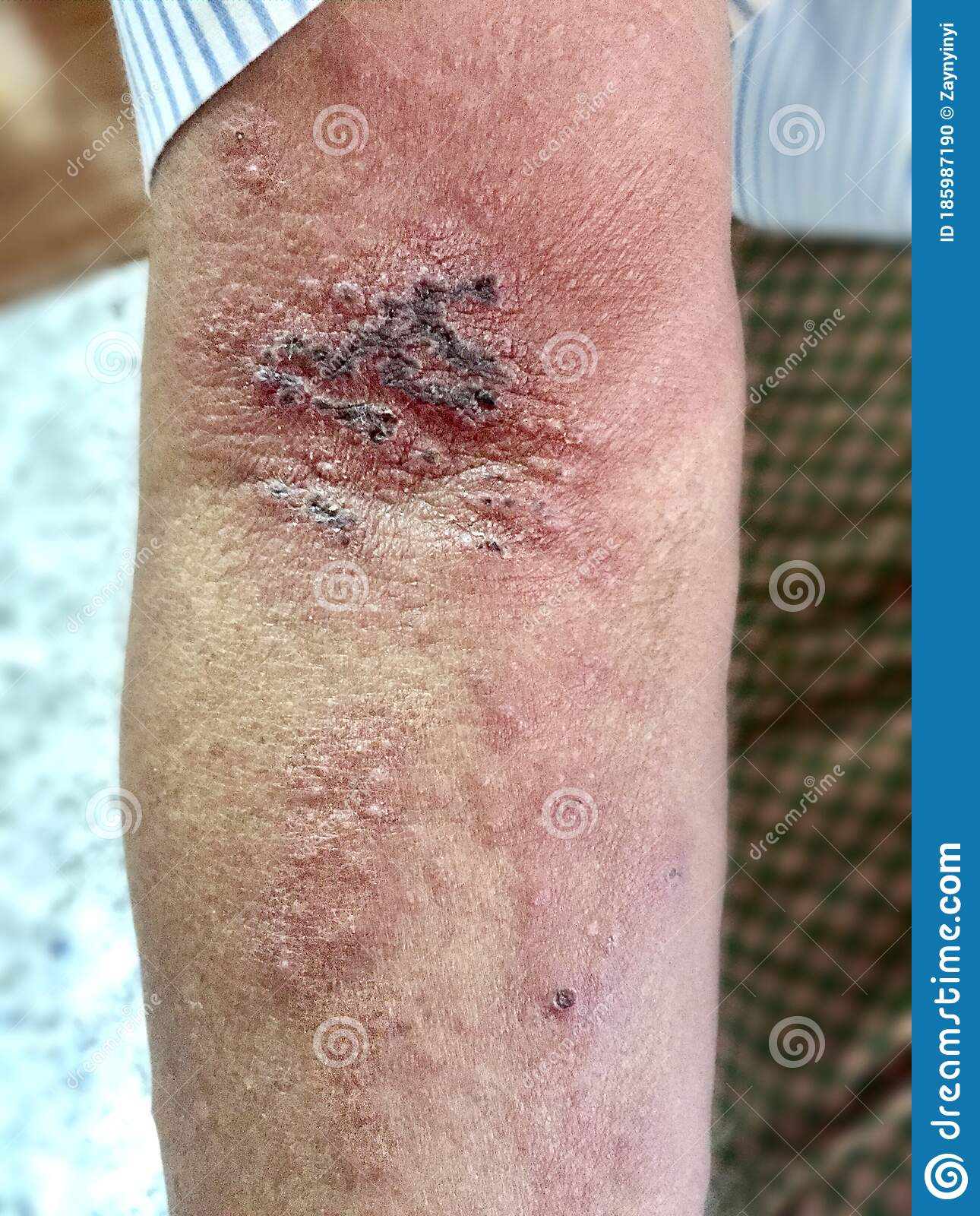 Shingles Or Herpes Zoster Infection In Left Arm Of Southeast Asian ...