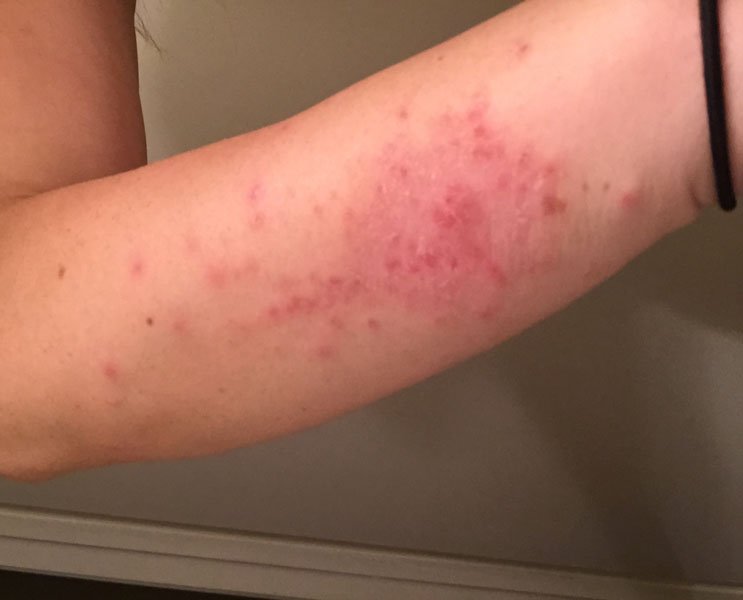 Shingles Rash on Arms and Armpits: Symptoms, Treatment and Pictures