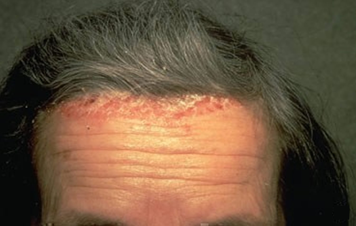 Shingles Scalp Only