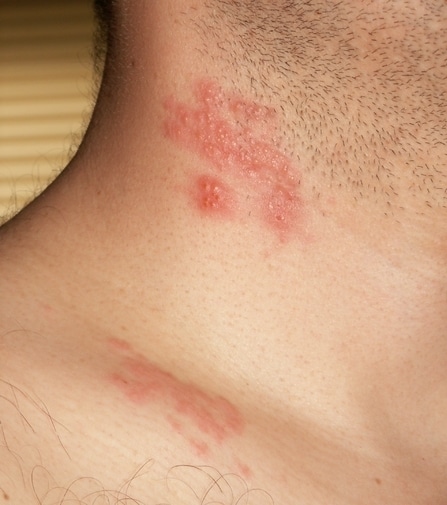 Shingles: Signs, Symptoms, Cause, Treatment, Is It Contagious?